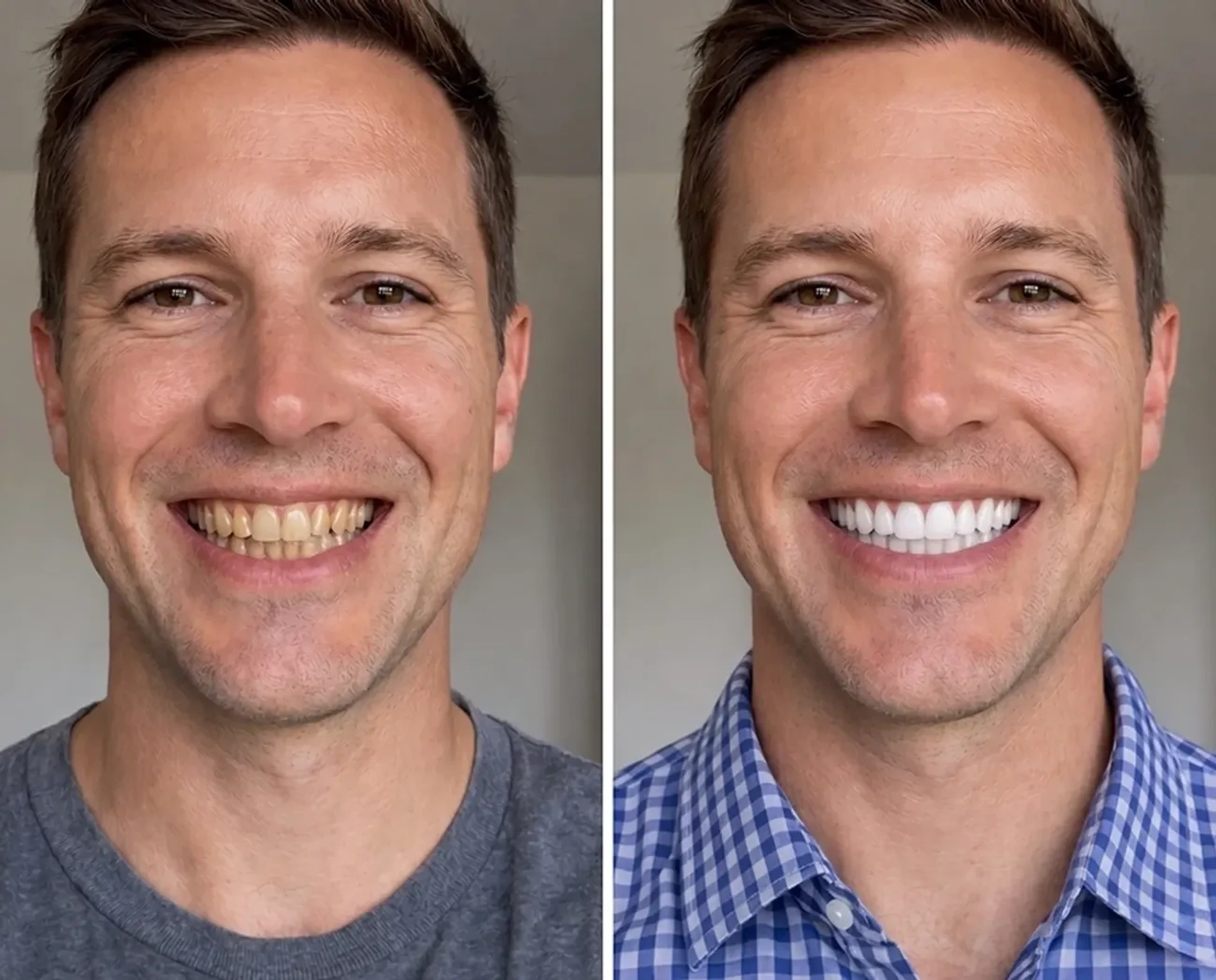 The same smile on day 1 and day 7 of using SHIMMER whitening tablets