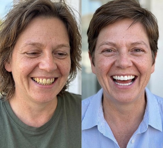 Verified user with a brighter, whiter smile after using SHIMMER